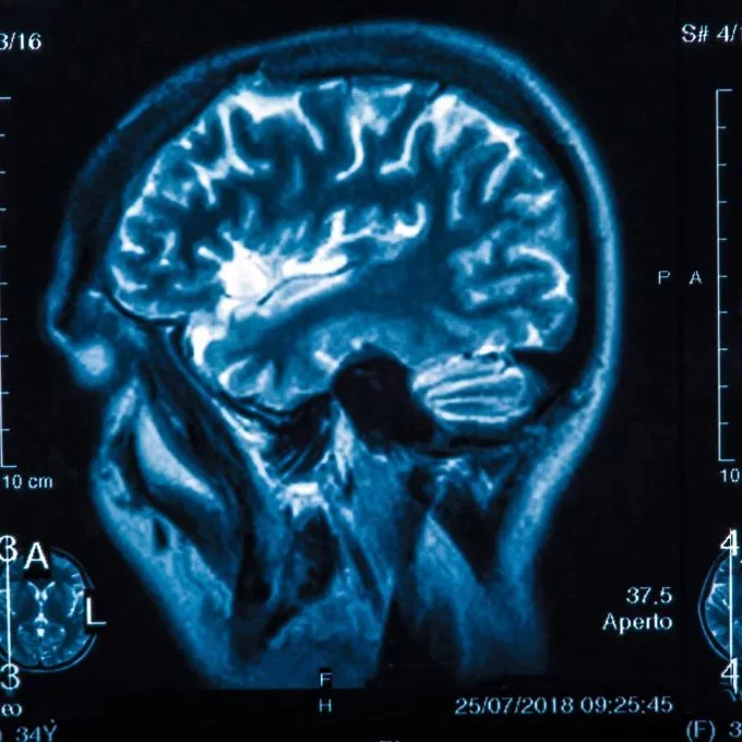 The X-ray of the human brain closeup