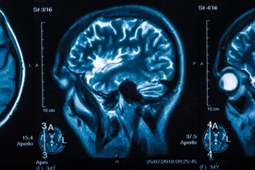 The X-ray of the human brain closeup