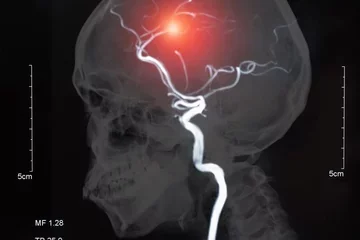 MRI of the blood vessels in the brain and cerebrovascular disease or or hemorrhagic stroke. brain stroke x-ray image.