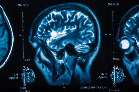 The X-ray of the human brain closeup