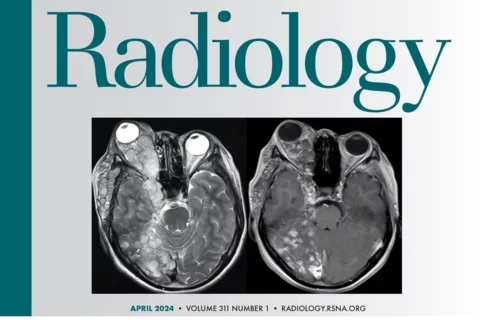 Journal Cover: Radiology Vol. 311, No. 1 (April 2024)