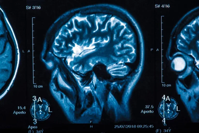 The X-ray of the human brain closeup