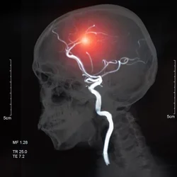 MRI of the blood vessels in the brain and cerebrovascular disease or or hemorrhagic stroke. brain stroke x-ray image.