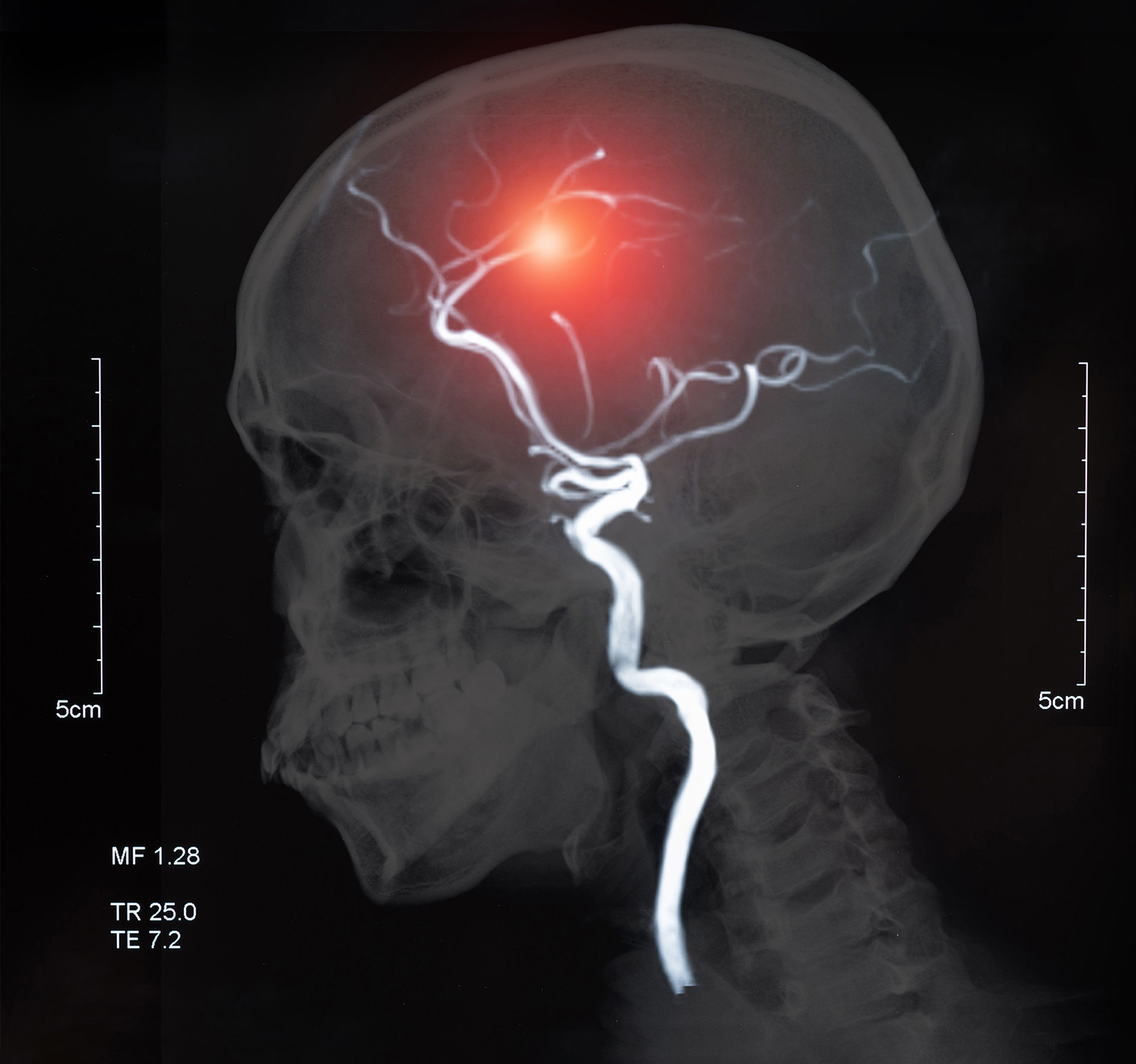 Understanding Intracranial Aneurysms